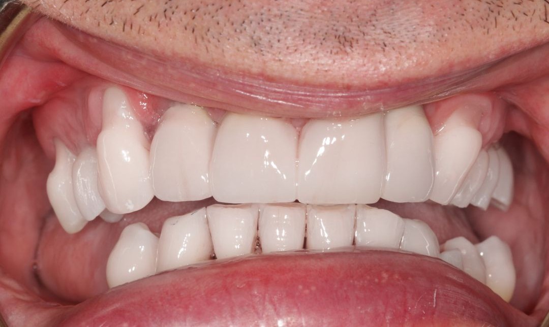 After — placeholder image, replace with a real consented patient photo